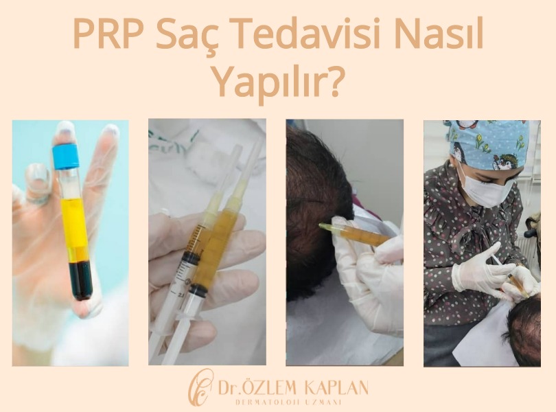 PRP Saç Tedavisi Nasıl Yapılır? Samsun Atakum