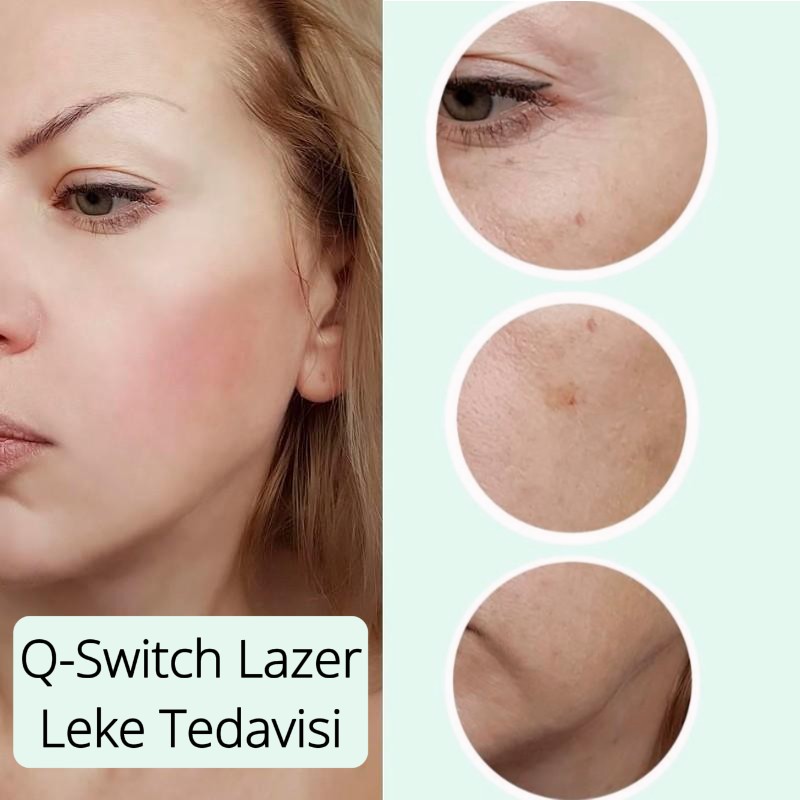 Q-Switch Lazer Leke Tedavisi Fiyatları Samsun, Atakum